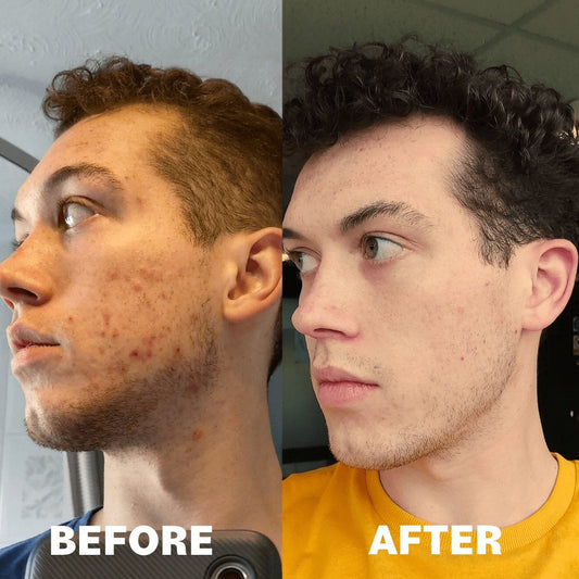 Understanding Sebum and Acne: A Deep Dive into Skincare Science - PORE FAVOR USA
