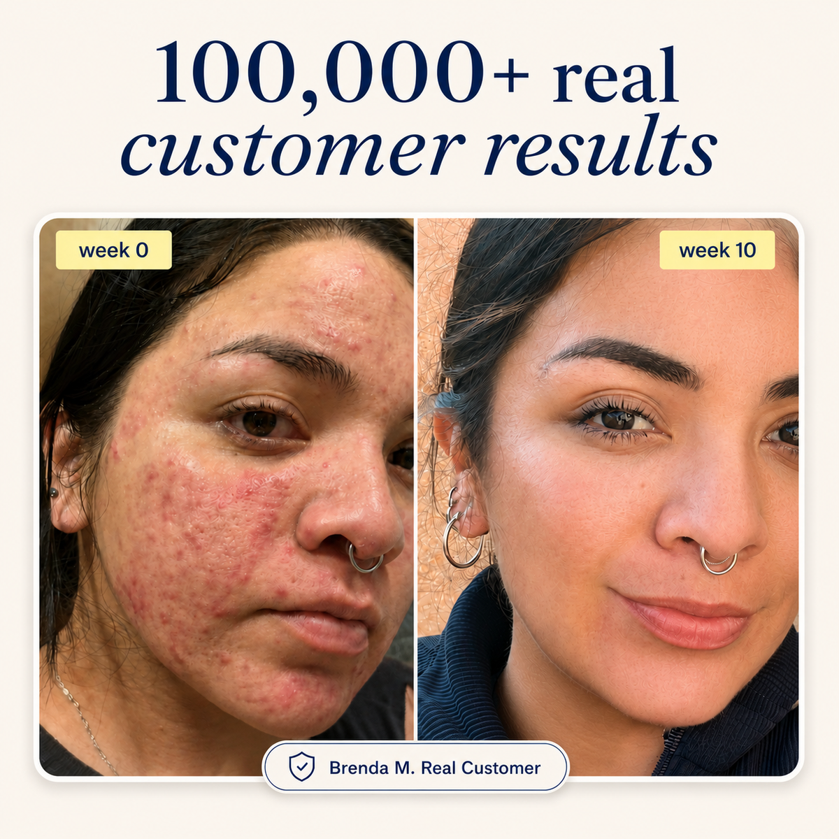 Acne Supplement