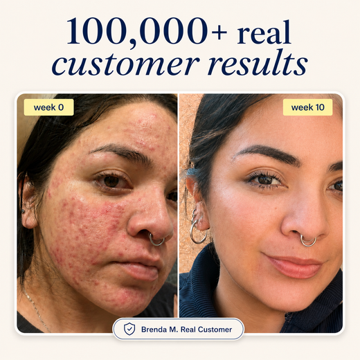 Acne Supplement