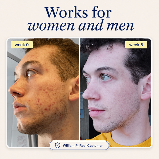 Acne Supplement