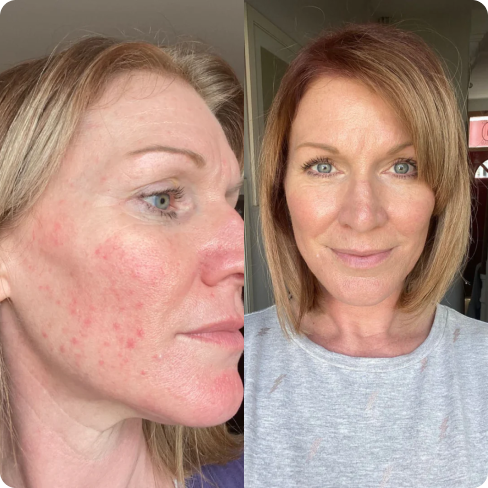 Before and after comparison of a woman's face with visible acne on the left and clear skin on the right.